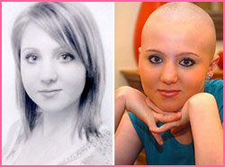 Schoolgirl Struck By Alopecia Loses All Her Hair - In Three Days